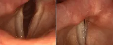 فلجی یه طرفه تارهای صوتیunilateral vocal fold paralysis
