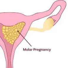 بارداری مولار چیست؟